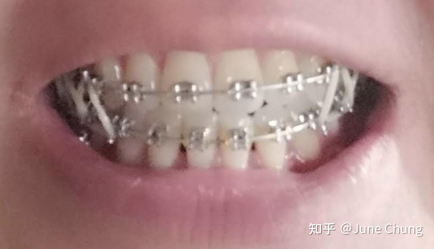 分享：我的牙套日记（矫正地包天），已完成。 - 知乎