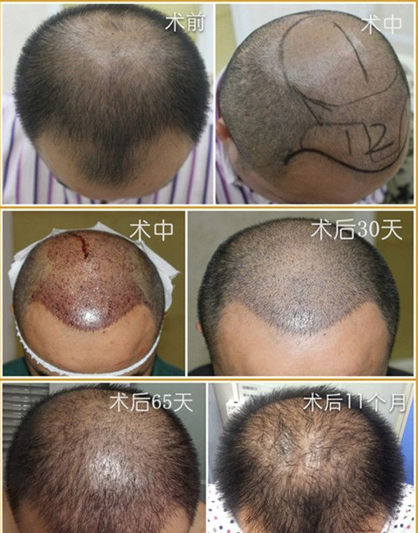 毛发移植对脑袋有伤害吗