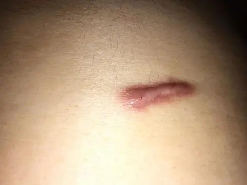 【肤康·科普】凹凸疤痕的5种类型,你是哪一类?