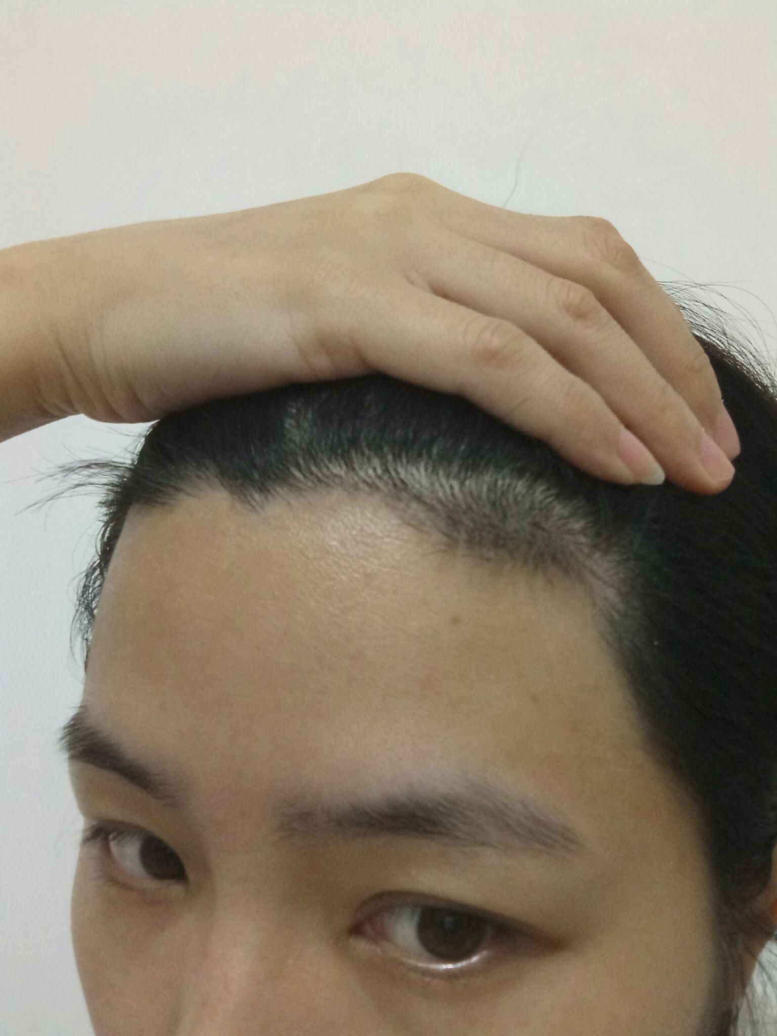 有没有因为额头低而脱发际线的