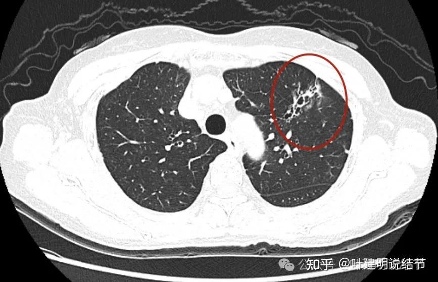 医生需要认识这类特殊的肺部阴影连续3年多家医院未认定肺癌但它就是