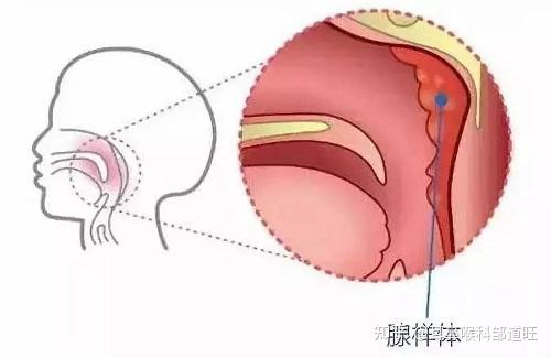 引起鼻塞,張口呼吸,睡覺打鼾,睡眠呼吸障礙等症狀時稱為咽扁桃體肥大