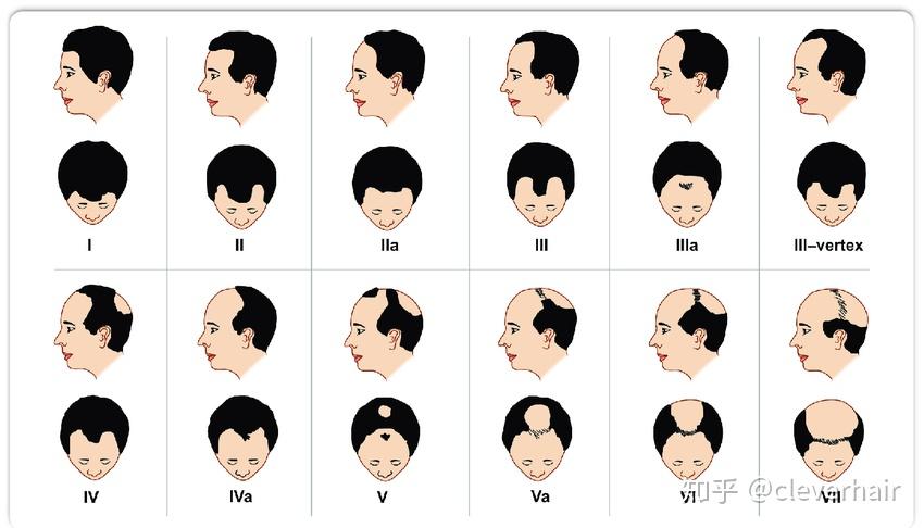非那雄胺你真的了解吗? - 知乎