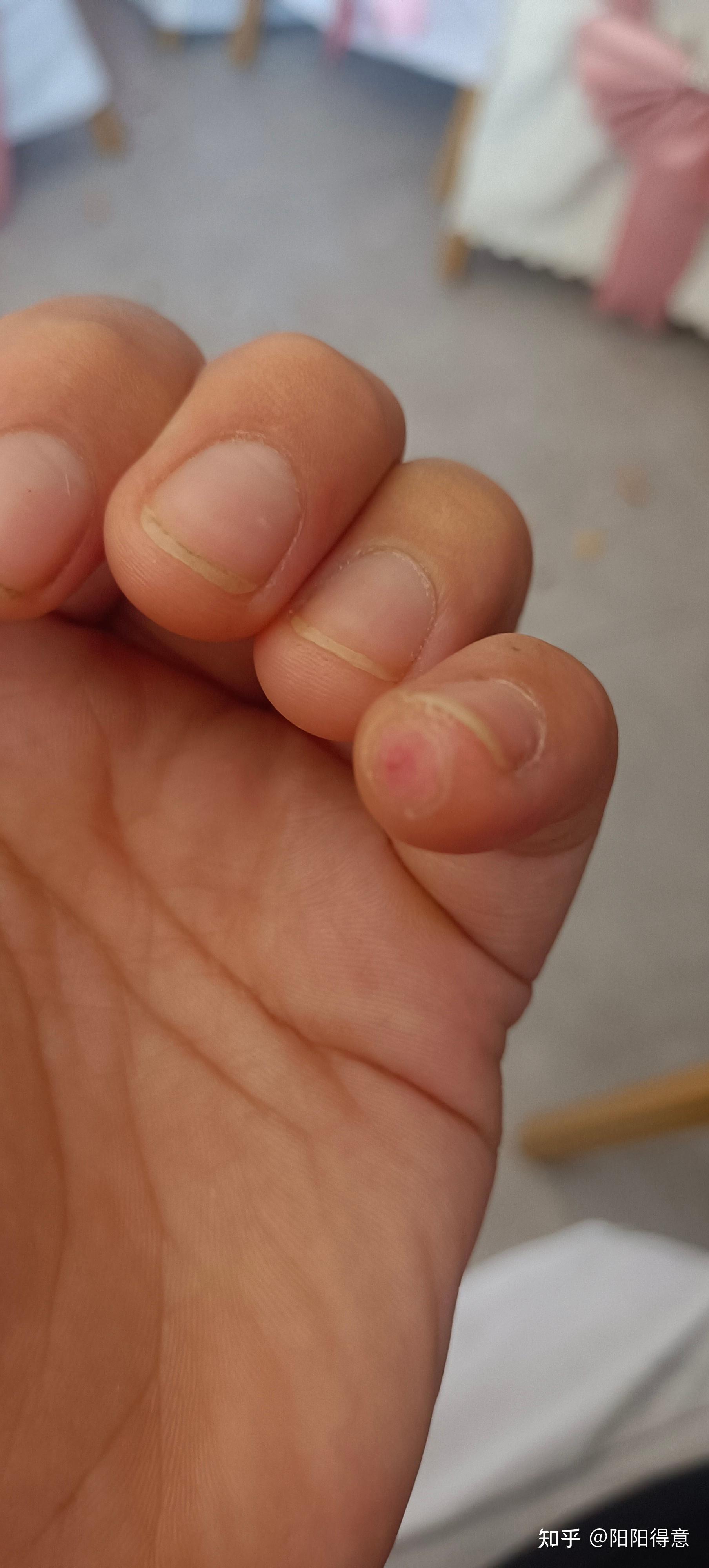 手指被切下一块肉,多长时间能恢复?