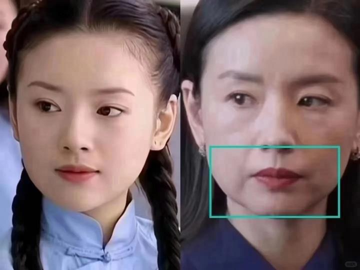 人中太长,为了显幼态到底要不要做人中缩短手术?到底会不会留疤? - 知乎
