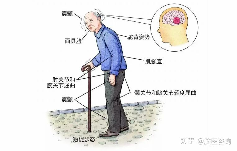 如何早期识别“帕金森病”? - 知乎