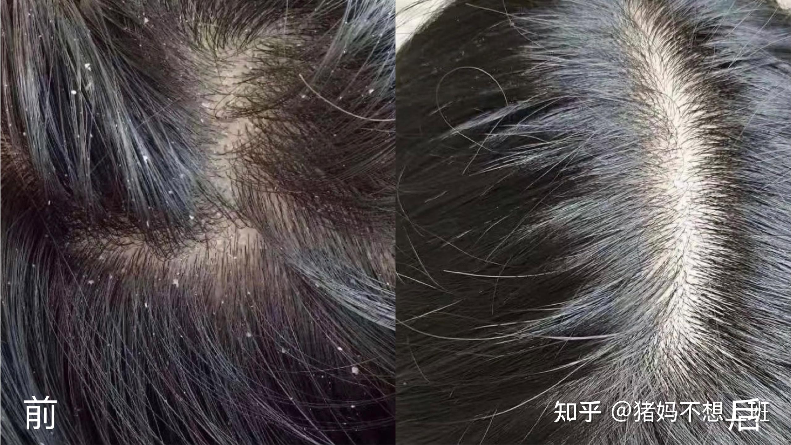 大块大块地掉头皮屑有什么好用的男士去屑洗发水推荐