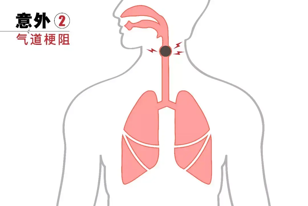 人体气道口和堵点图片