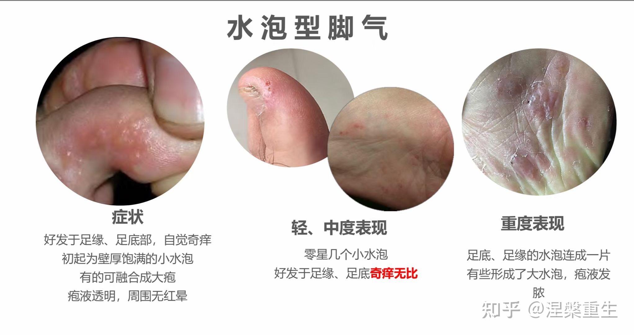 如果你有一个很漂亮的女朋友,她被家里人传染了脚气,你会跟她分手吗?