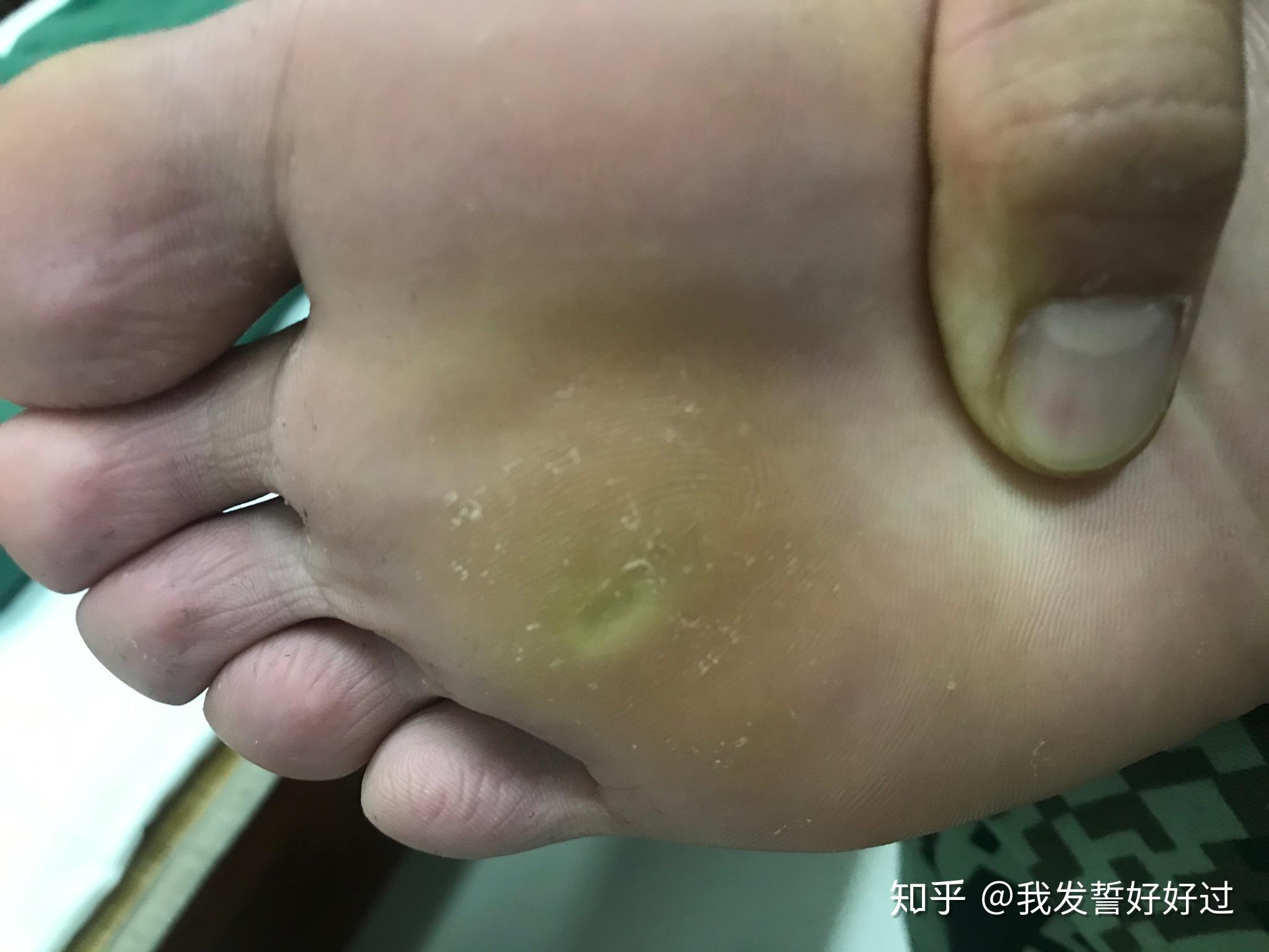 我是體育生經常長跑和打球前腳掌長了個類似繭的東西可是泡完腳拿刀片