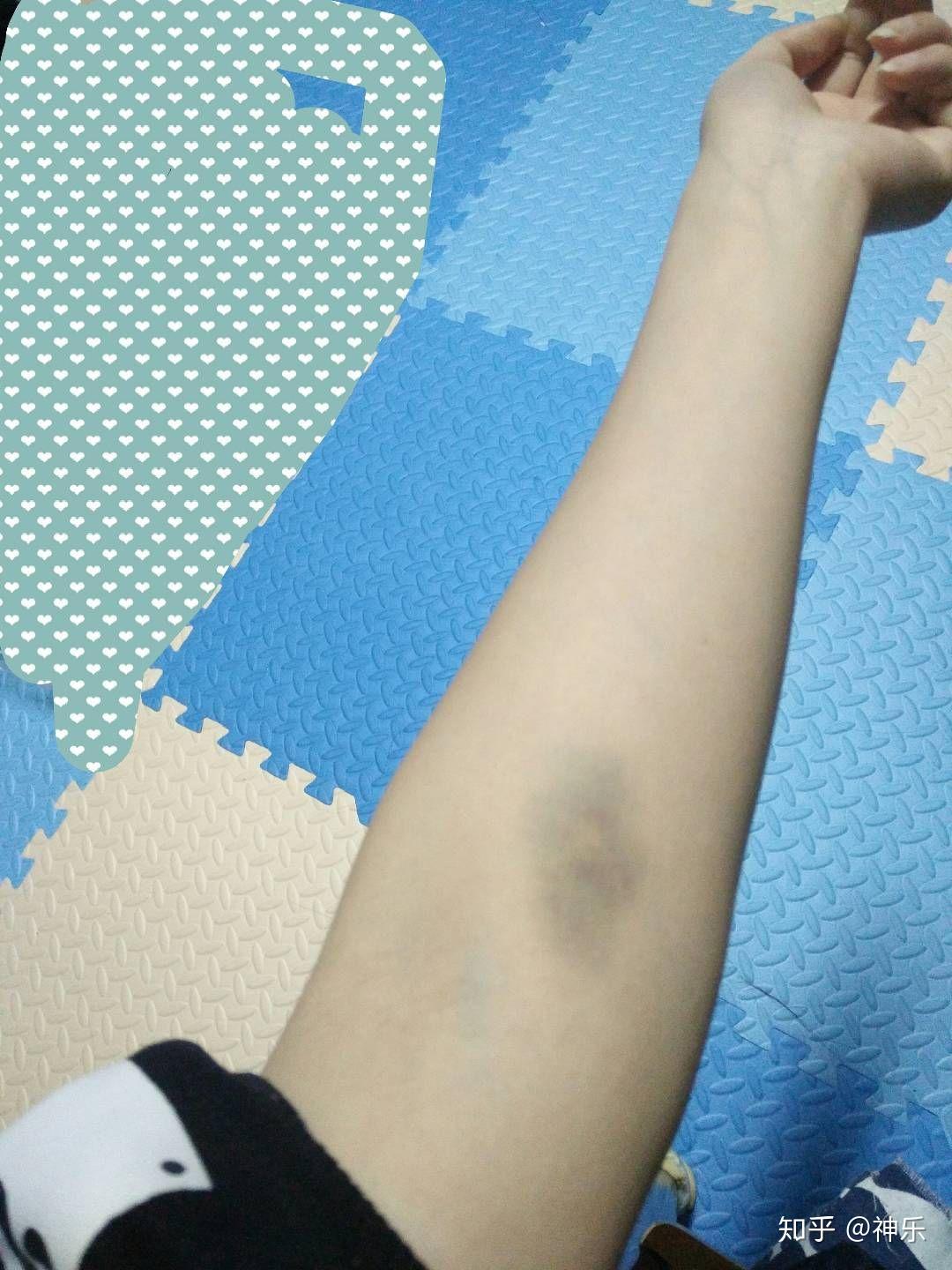 身上总会莫名其妙起淤青是什么原因? - 知乎