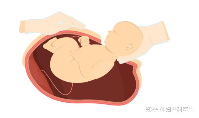 今天我們只說最常見的頭位子宮下段切口剖宮產,不聊臀位,橫位,體部