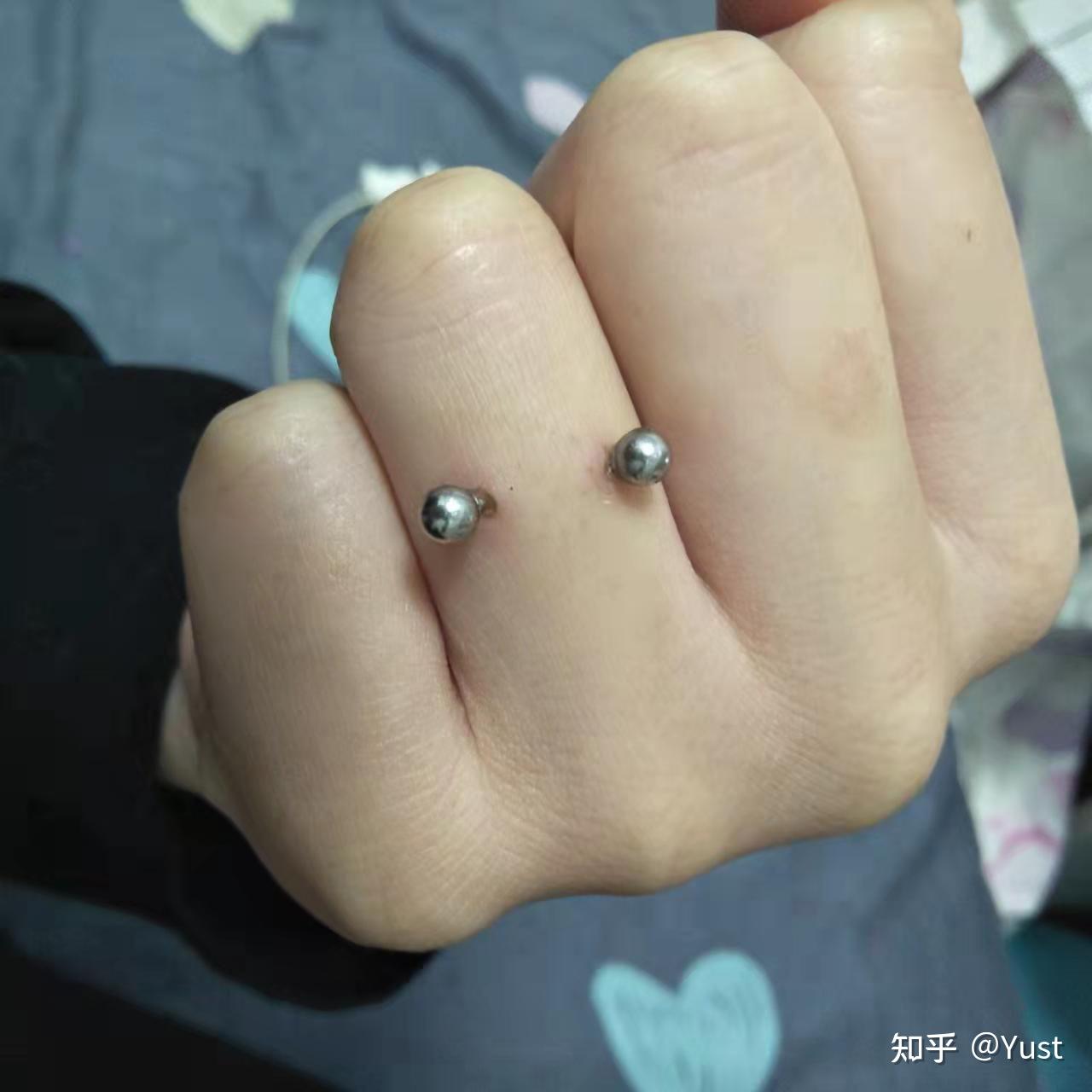 手指钉forwardhelix恢复记录