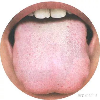 小儿常见草莓舌 - 知乎