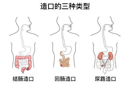 临时造口图片