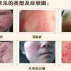 皮肤过敏有多痛苦 该如何缓解 知乎