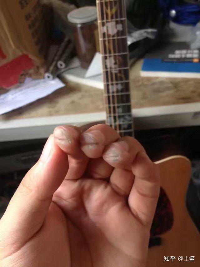 练吉他的时候左手按弦手指尖疼而且爆皮了怎么办