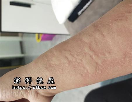 羊肉过敏引起的,建议立即停止食用,同时多喝水,促进排便排尿,症状比较