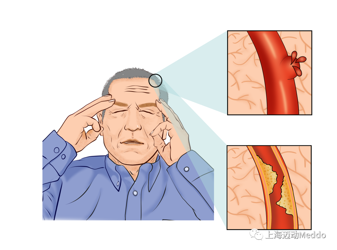一文带您了解脑卒中偏瘫后早期康复的重要性 - 知乎