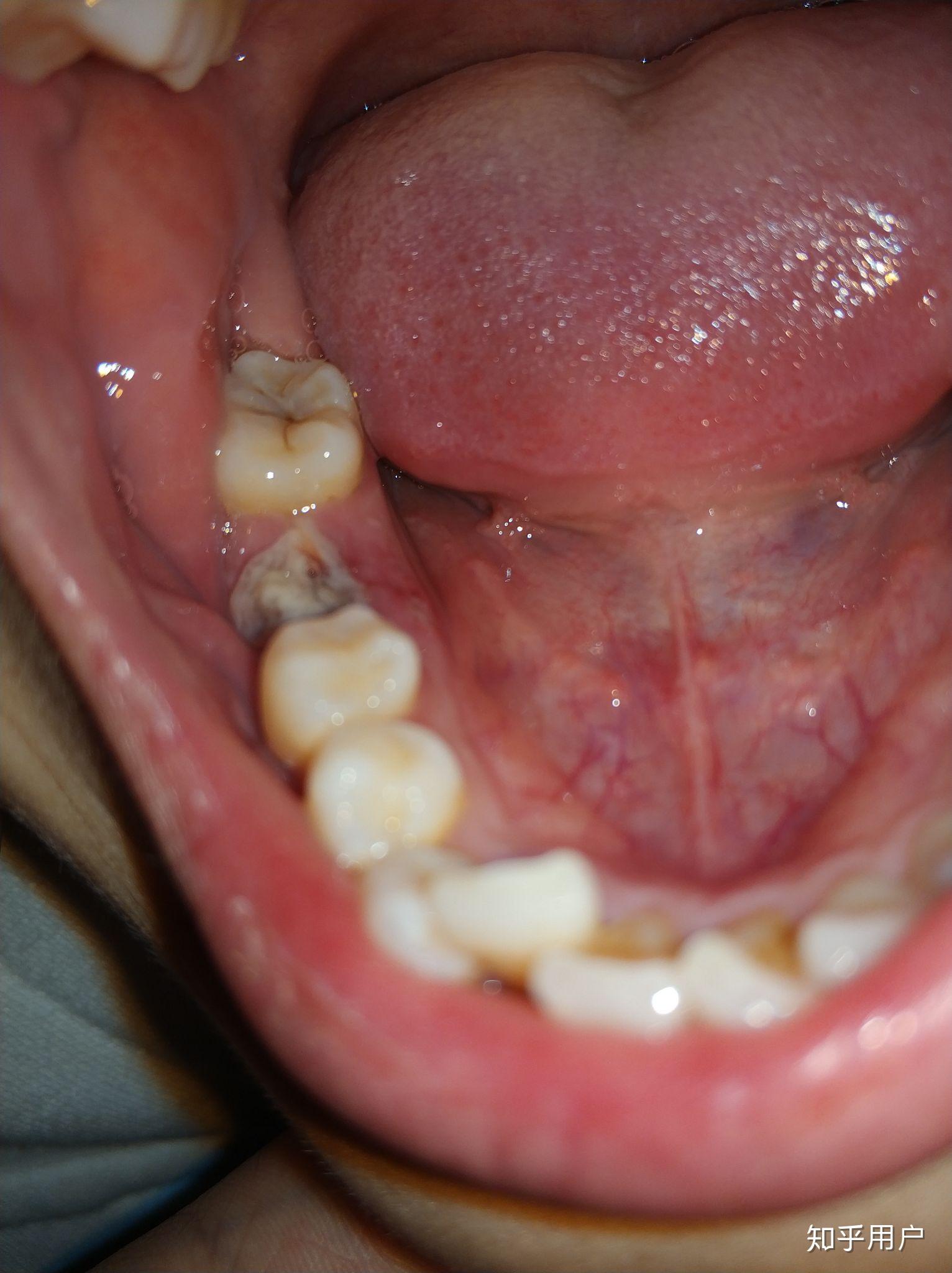 拔牙后恢复过程全解