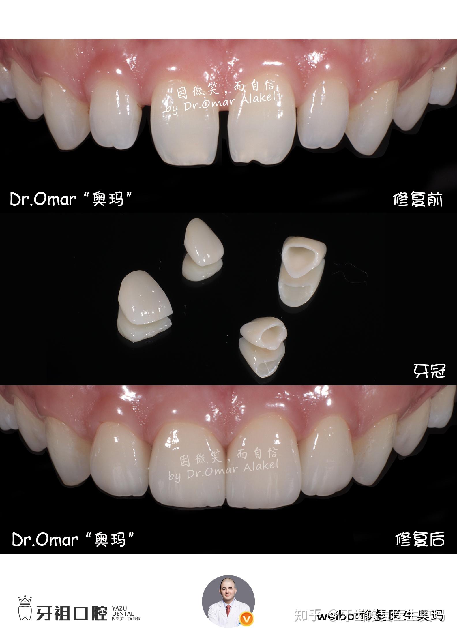 修复案例分享全瓷冠修复门牙缝隙