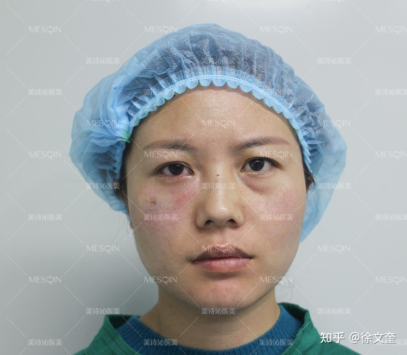 眼袋的形成原因及常见的处理方式-杜太超-爱问医生