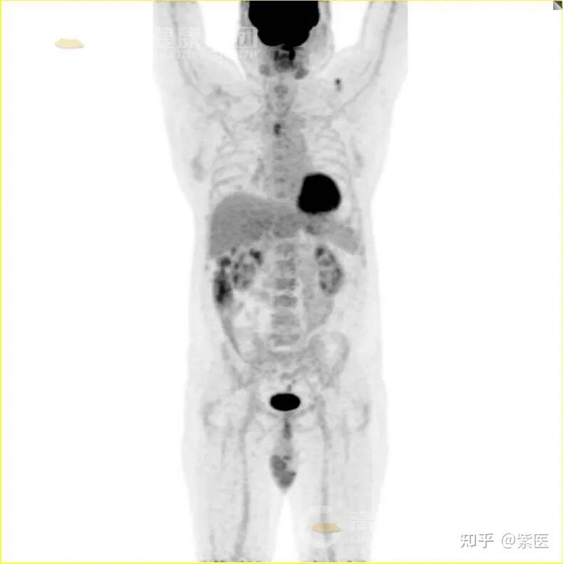 Bbb Ct PET/CT诊断气管腺样囊性癌 - 知乎