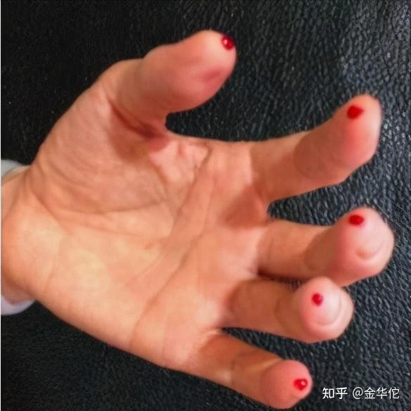 放血疗法有什么功效?