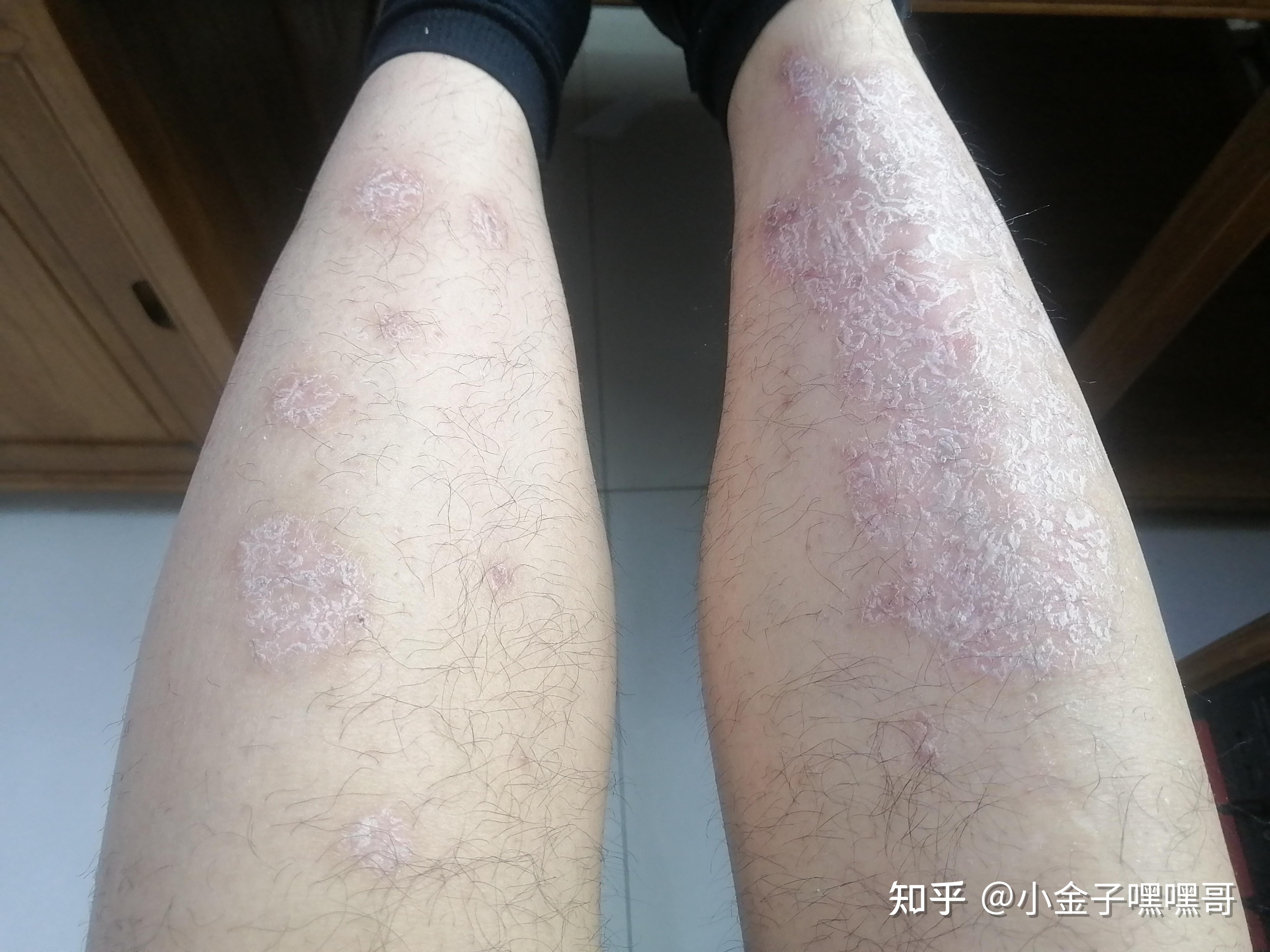 真实记录使用可善挺的效果