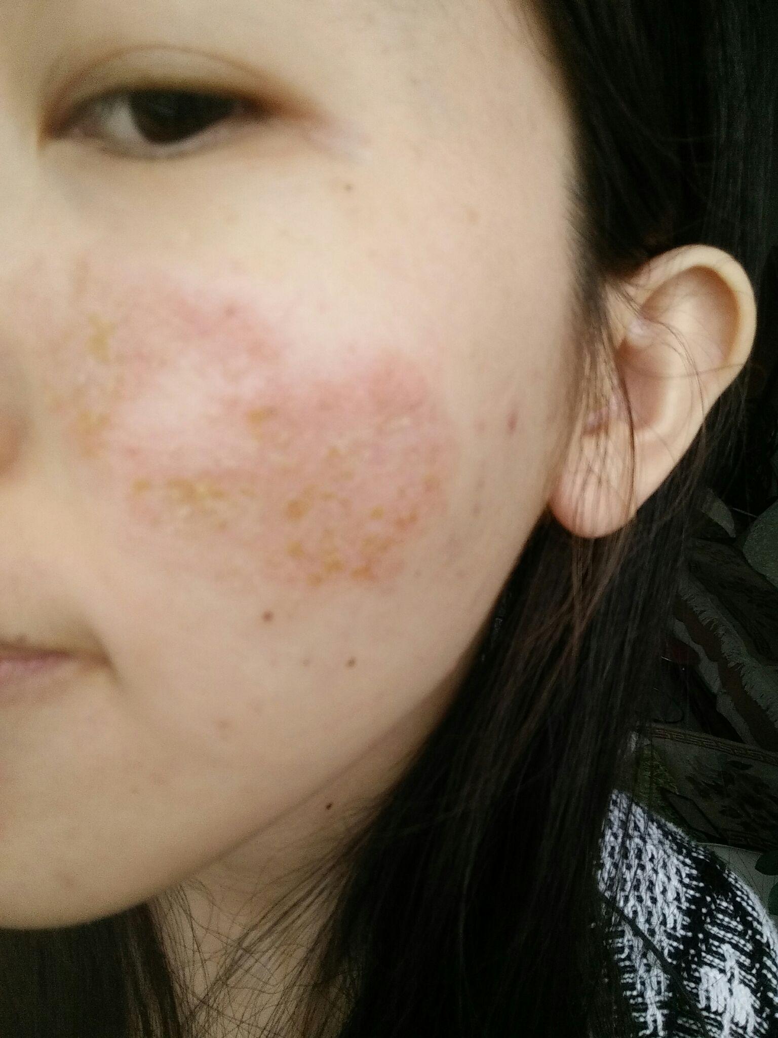 得了面部皮炎,如何乐观地生活? - 知乎
