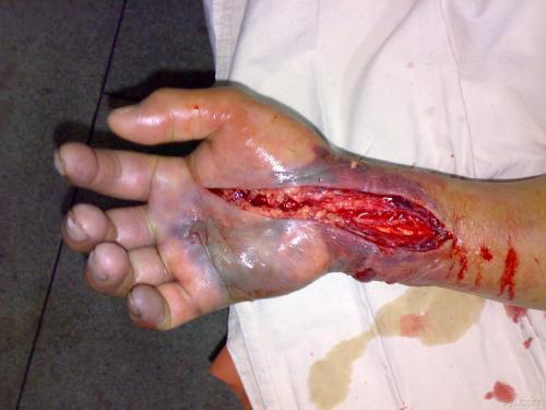 痛painlessness,无脉pulselessness,苍白pallor,感觉异常paresthesia