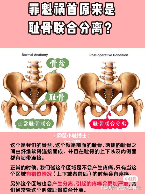 耻骨联合分离的原因及危害 耻骨分离的原因 茶文网