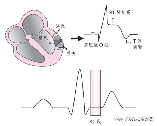 坏死性q波是什么图片