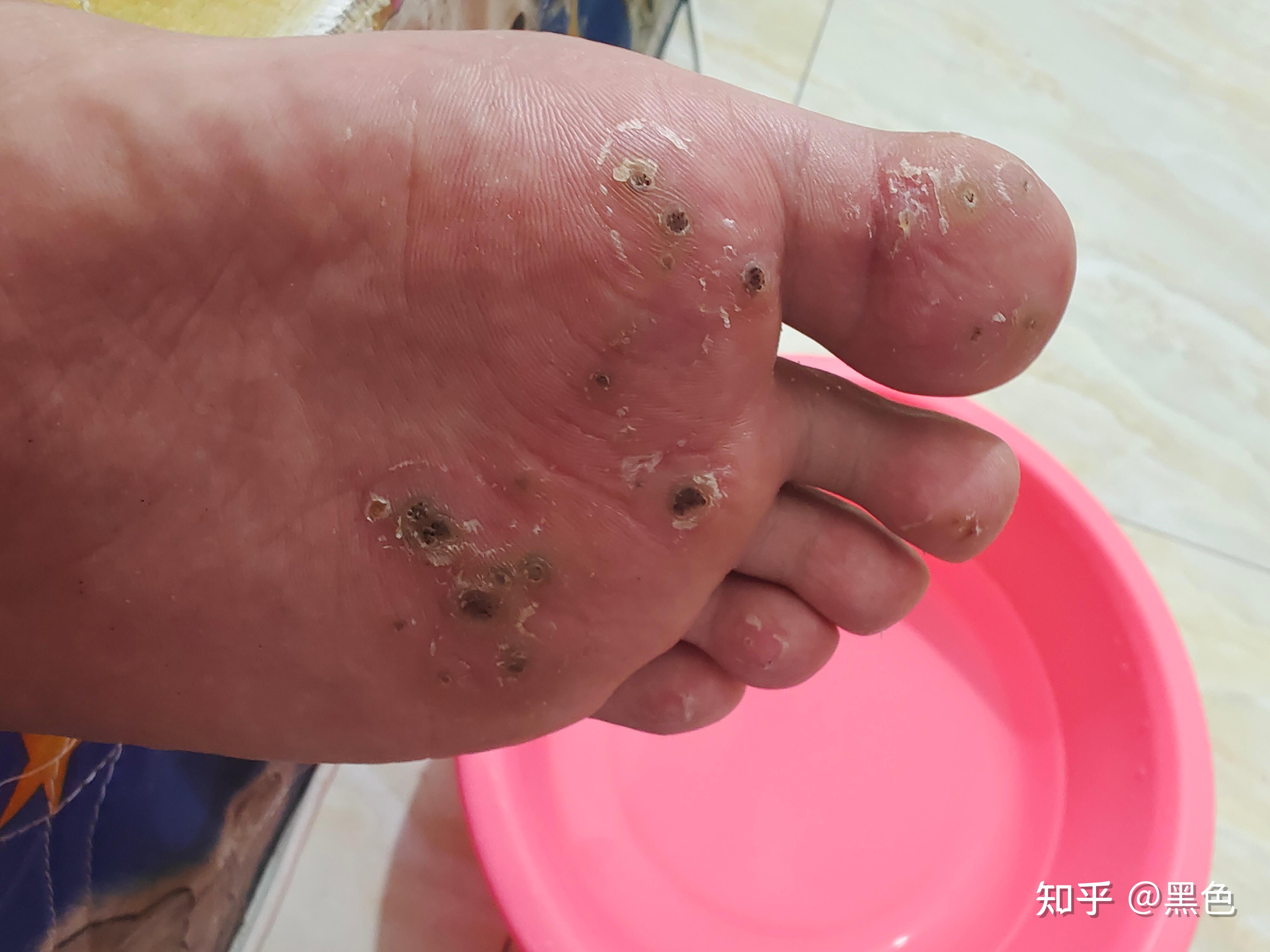 记录跖疣治疗过程