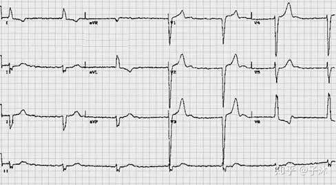 心电图显示正常心电图图片