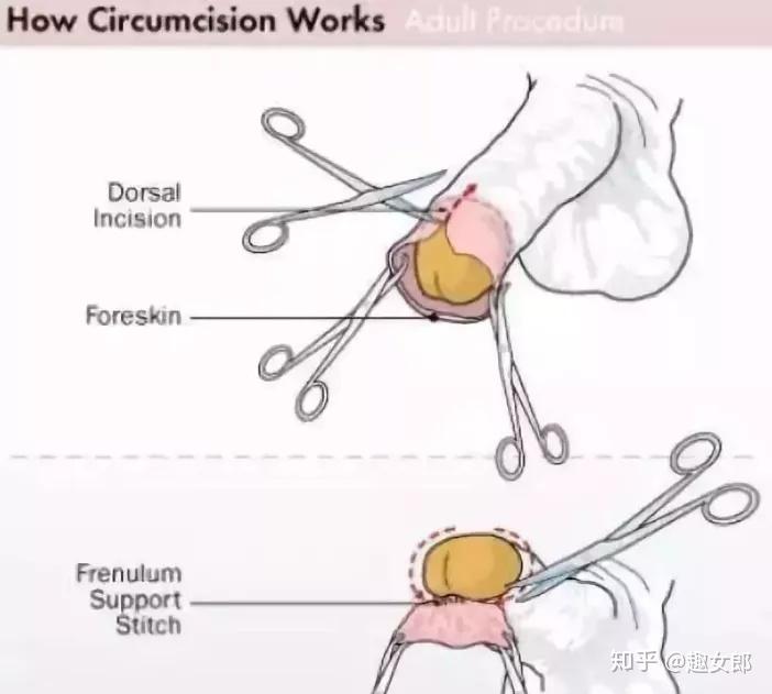 包茎手术拆线照片图片