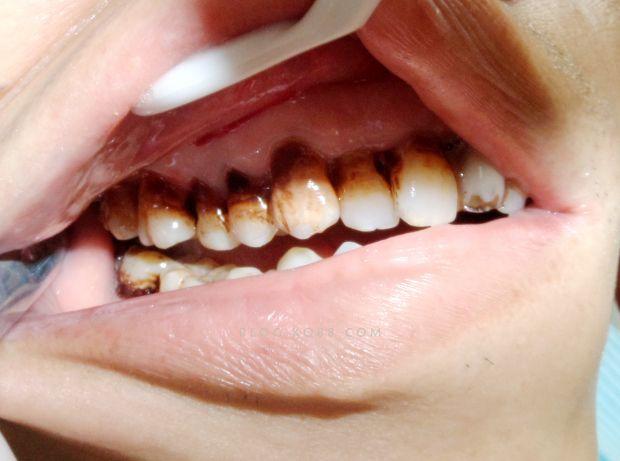 牙齿异常脱落不要忽视与它弄混连哭都没眼泪