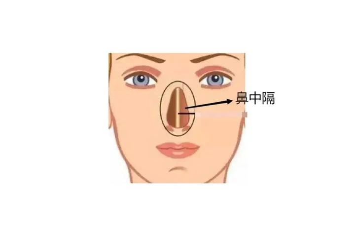鼻中隔偏曲一定要手术吗?医生帮你理清治疗选择的纠结 - 知乎