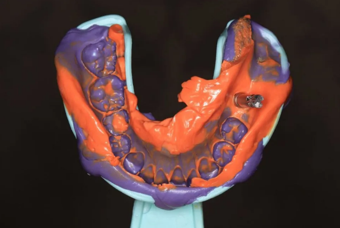 种植牙科普 | 种植牙之取模篇——取模很重要,方法需谨慎