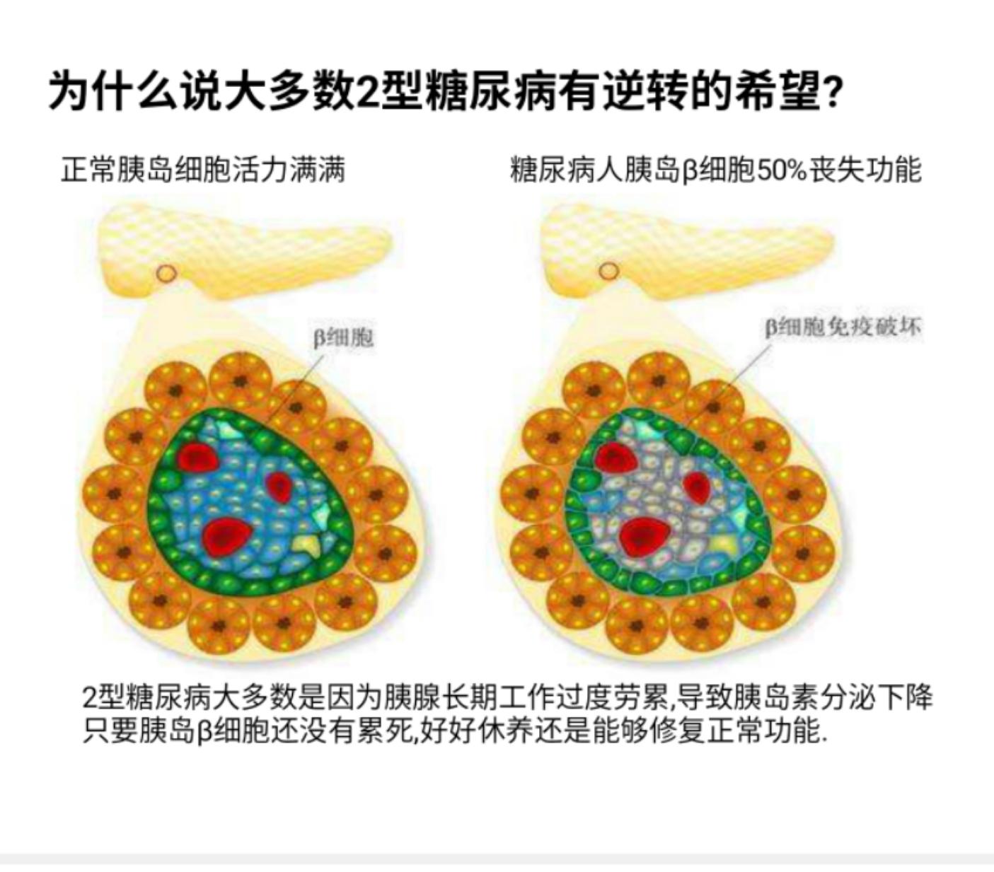 为什么说糖尿病是可以逆转的 逆转的定义 知乎