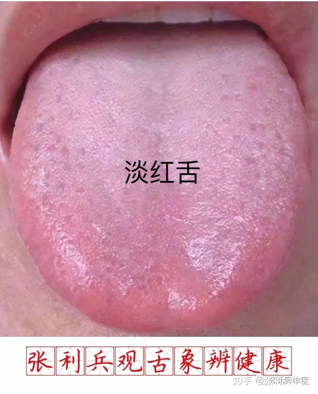 正常舌象的特点及临床意义 – 中医舌诊图片 _ 舌中有裂纹是什么原因,怎么调理呢? – AYWELV