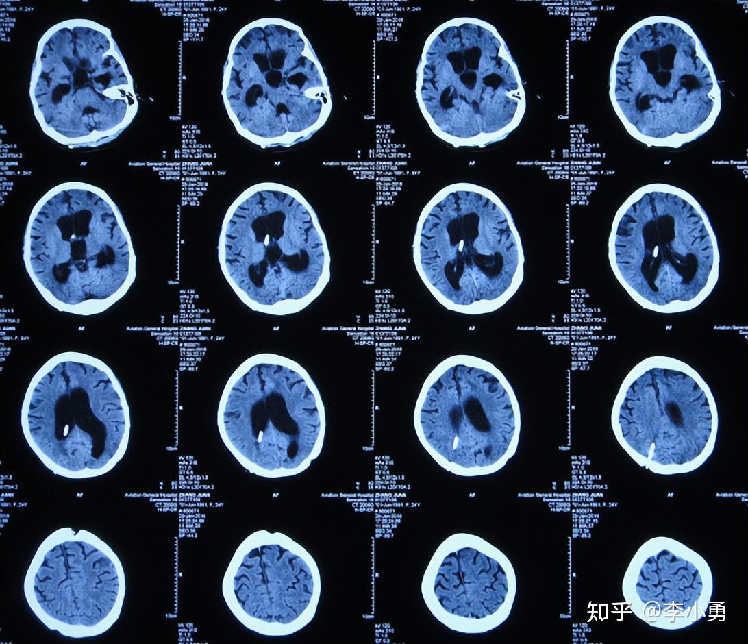 檢查ct後發現有腦積水(圖-1),再查頭顱核磁(圖-2)後認為是