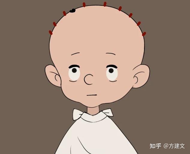 本身就头发稀少,有办法植发吗? - 知乎