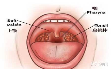 令人烦恼的少儿扁桃体发炎 - 知乎