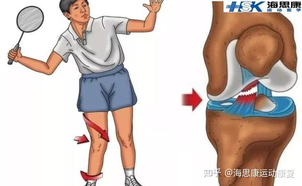 前交叉韧带损伤原因! - 知乎