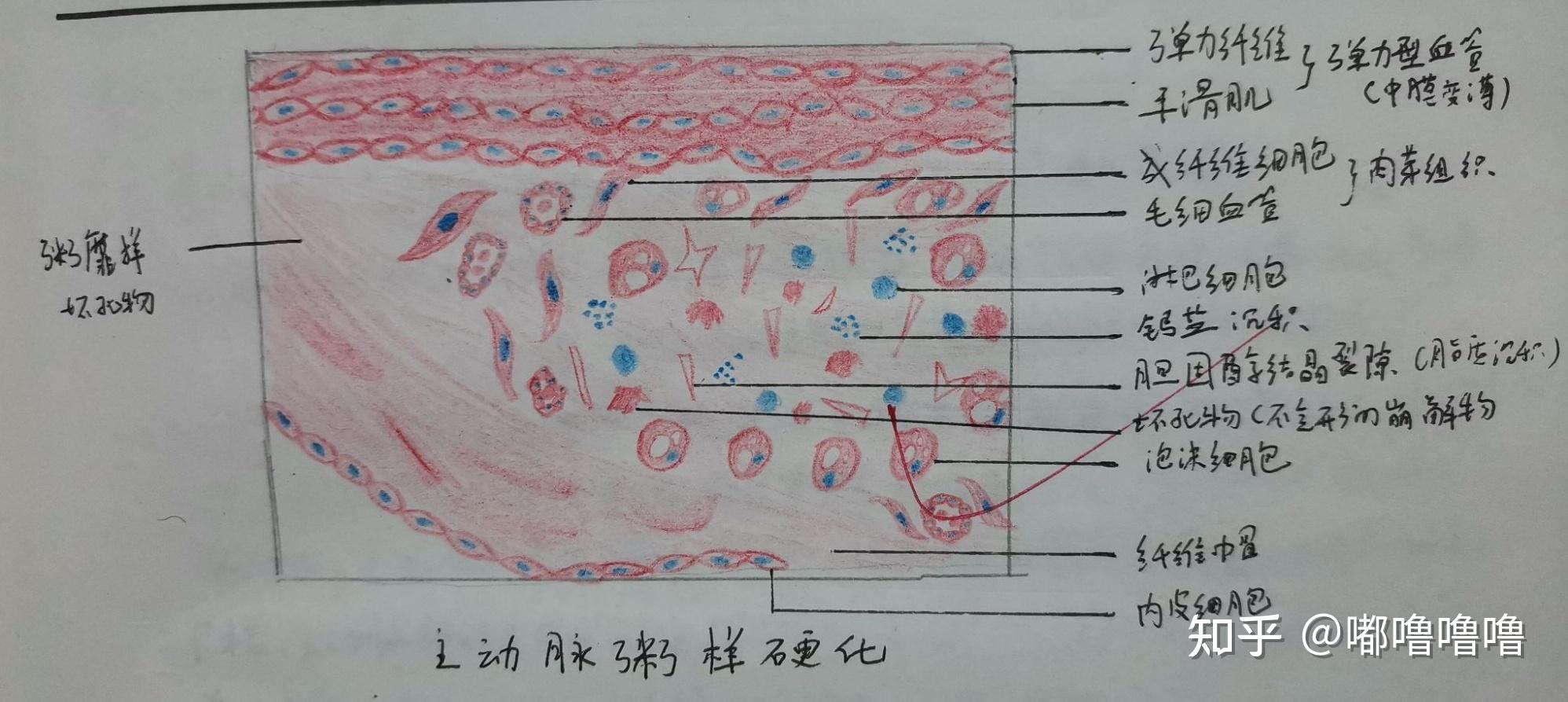 纤维素样坏死手绘图片