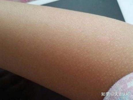 什么人会有鸡皮肤图片的简单介绍 什么人会有鸡皮肤图片的简单介绍