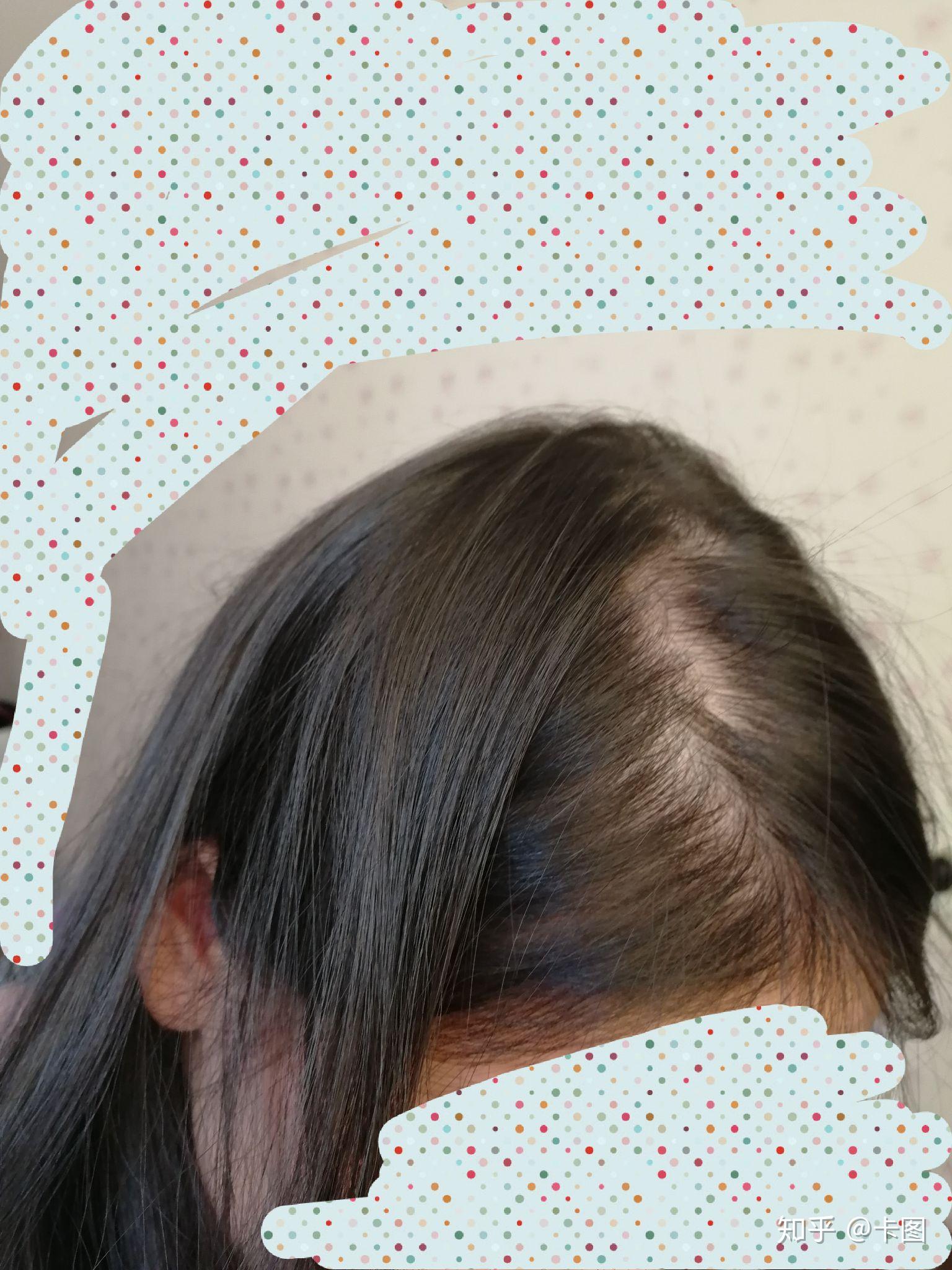 女生头顶头发少是什么体验