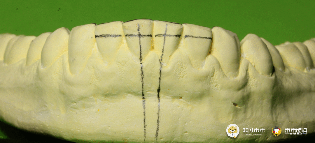 3,在93膏模型唇舌侧画出需调整牙的 牙体长轴线(轴倾度参考) 临床冠