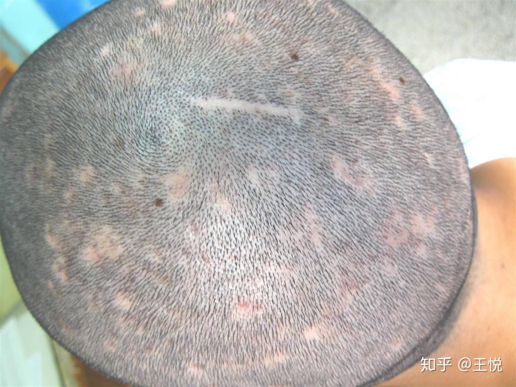 毛囊炎怎么办?又该如何治疗? - 知乎